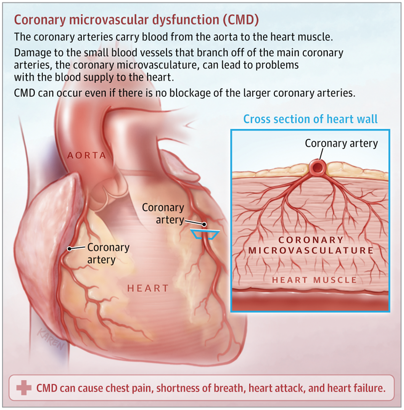 Coronary Microvascular Dysfunction