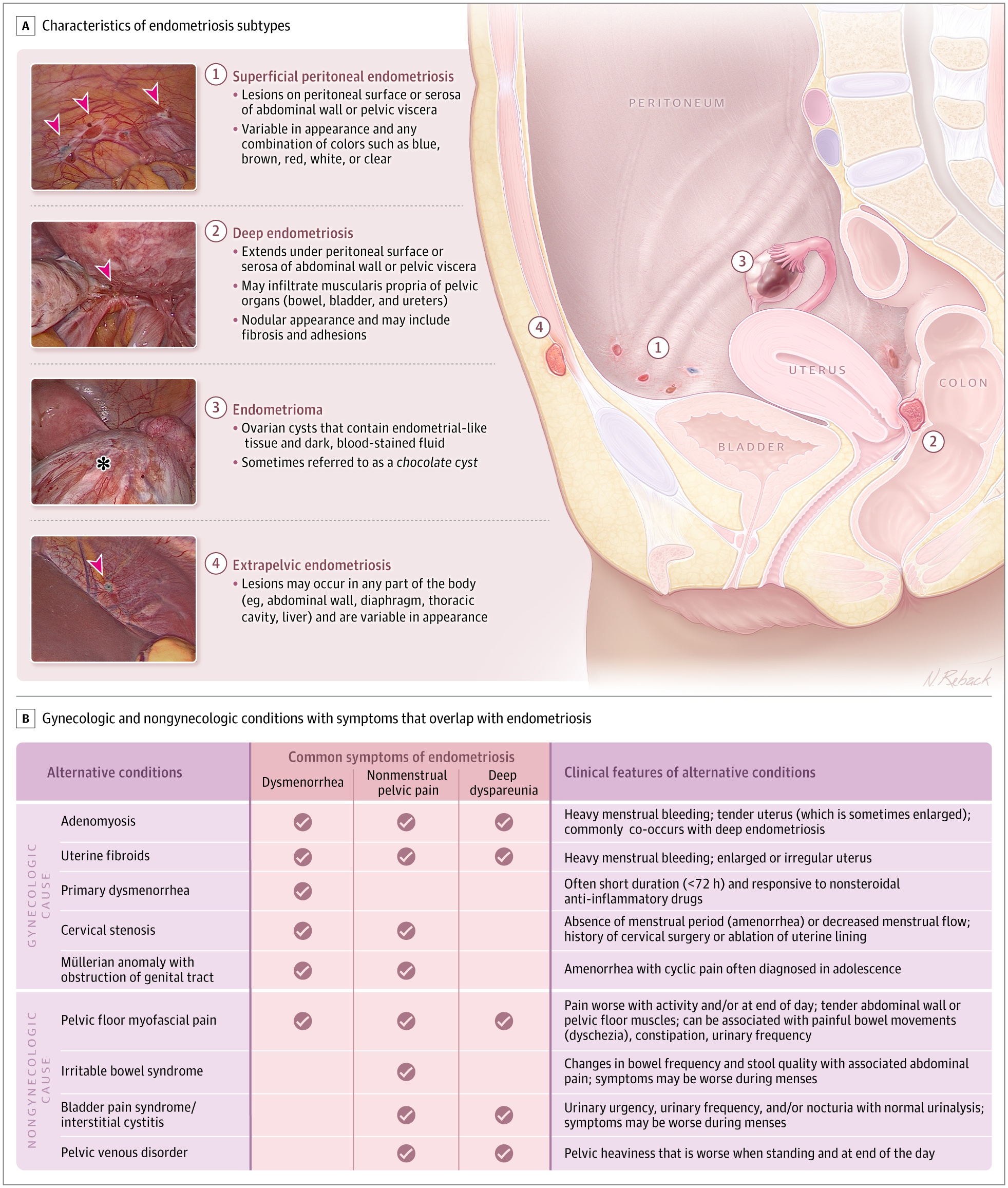 Endometriosis