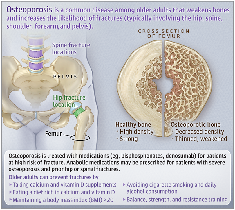 Osteoporosis