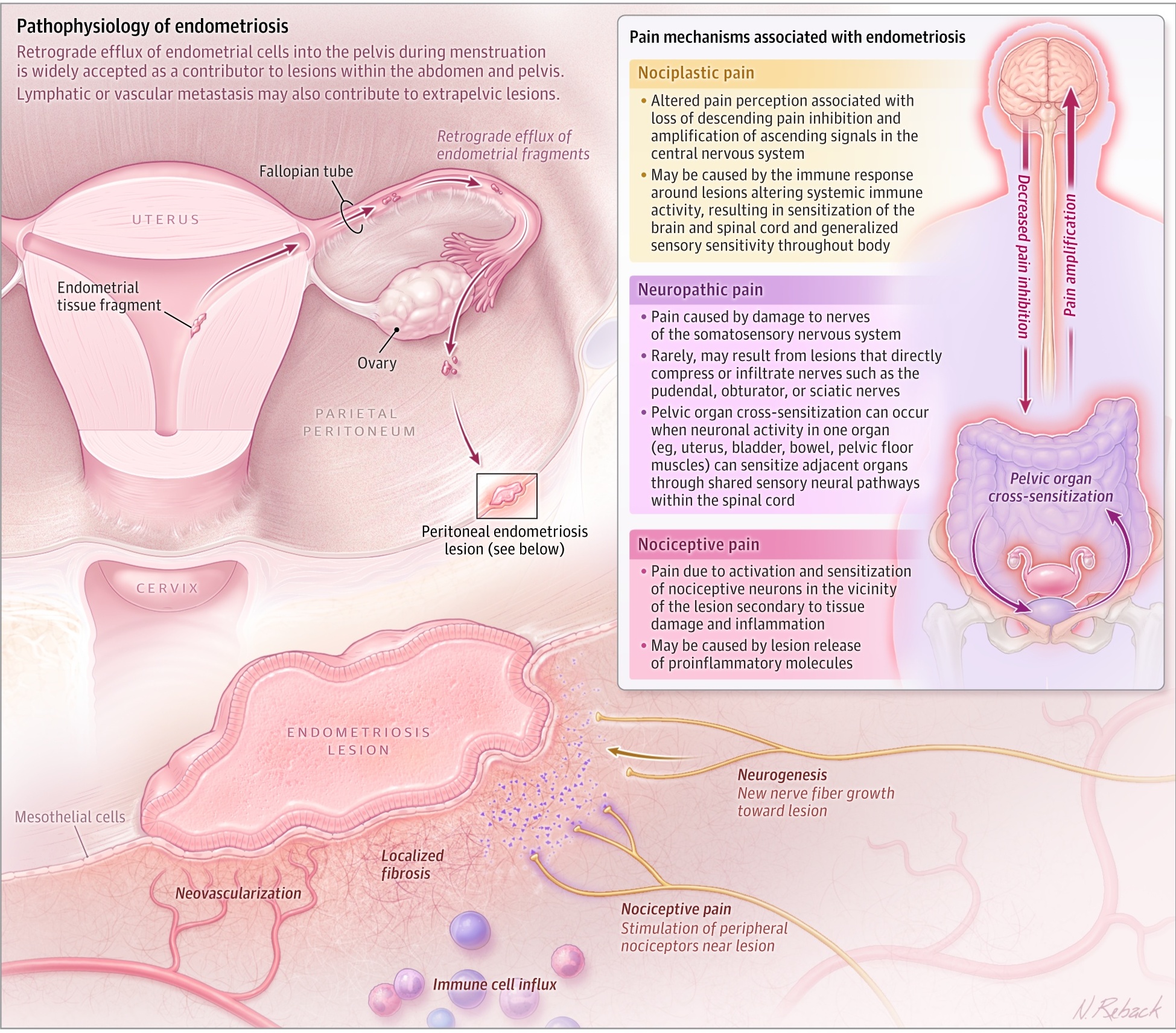 Endometriosis - pathophysiology