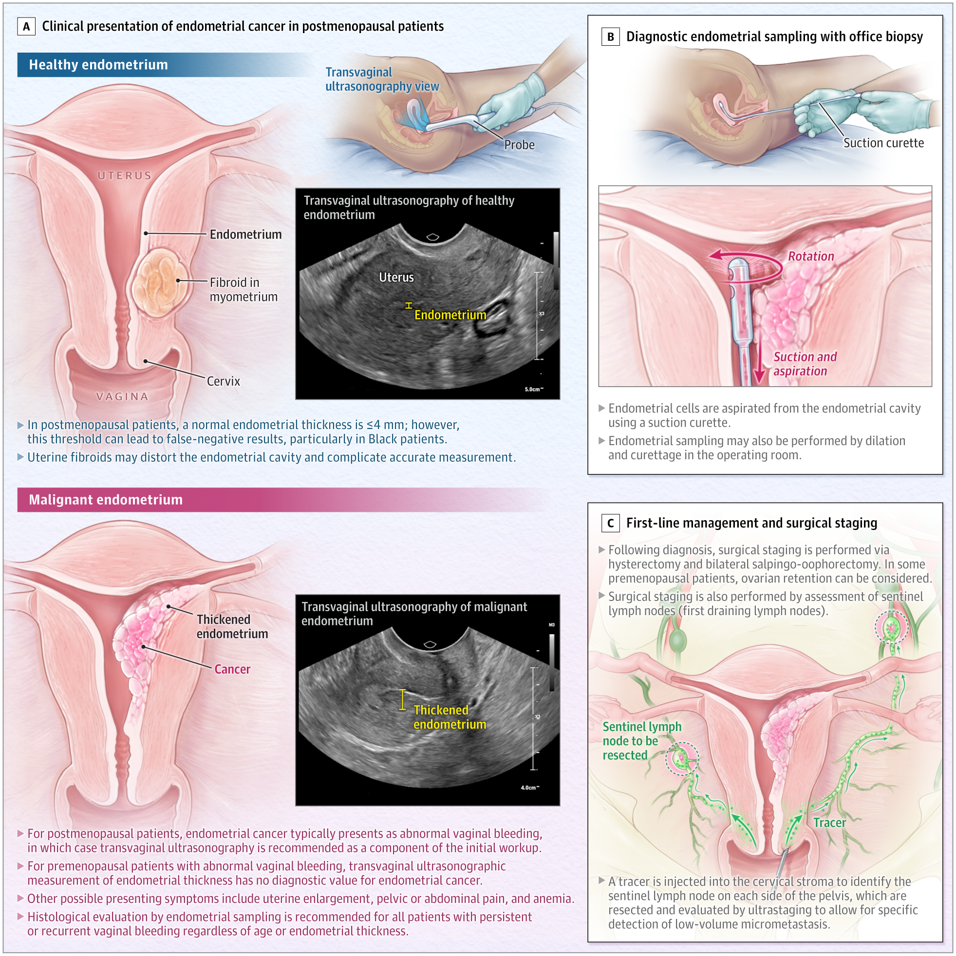 Endometrial Cancer