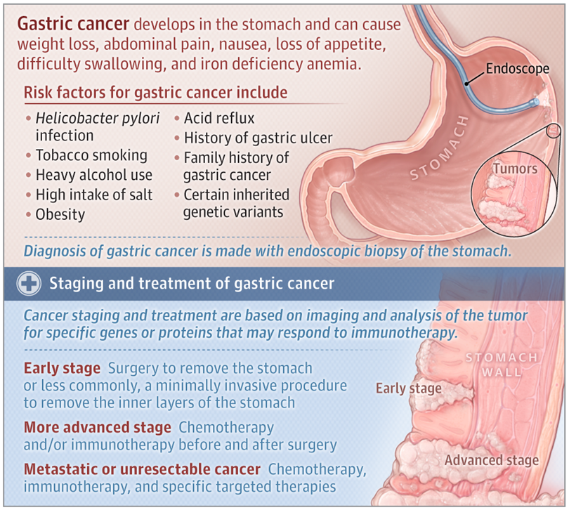 Gastric Cancer