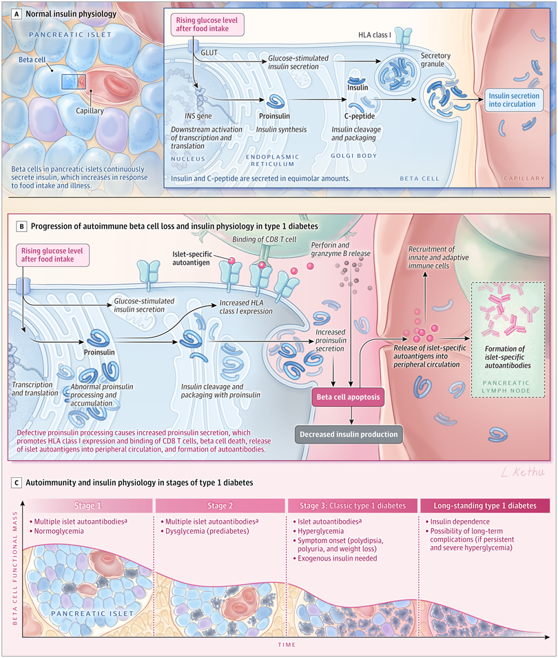 Type 1 Diabetes